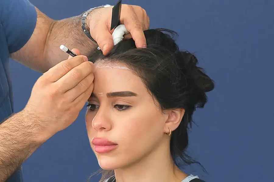 implant de păr femei