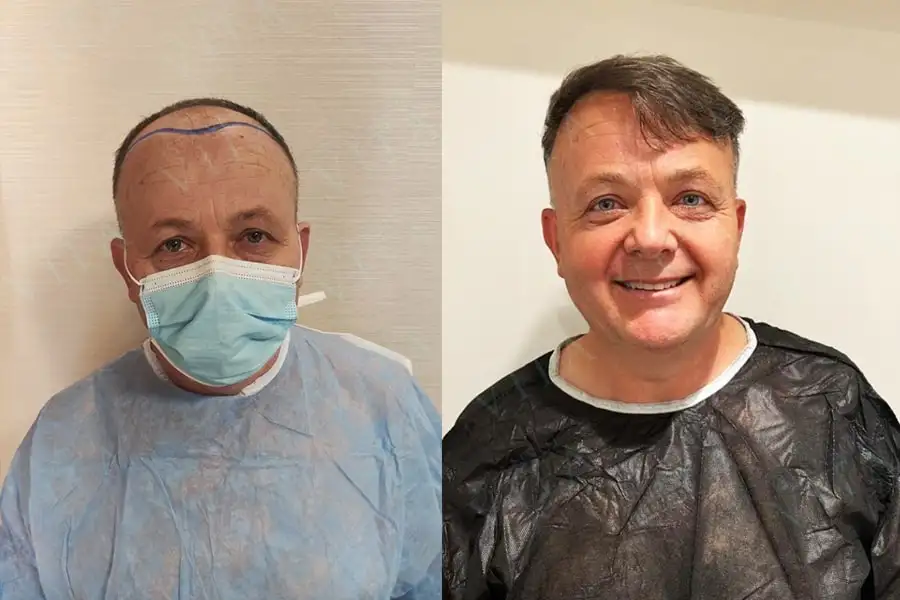 înainte și după implant de păr