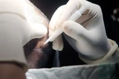 ▷ Ce este implant de păr DHI? Preț 2024 | Istanbul Vita